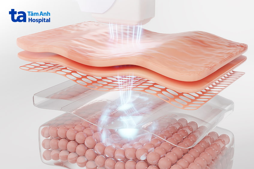Mô phỏng công nghệ laser tác động sâu vào tầng biểu bì để điều trị tổn thương da