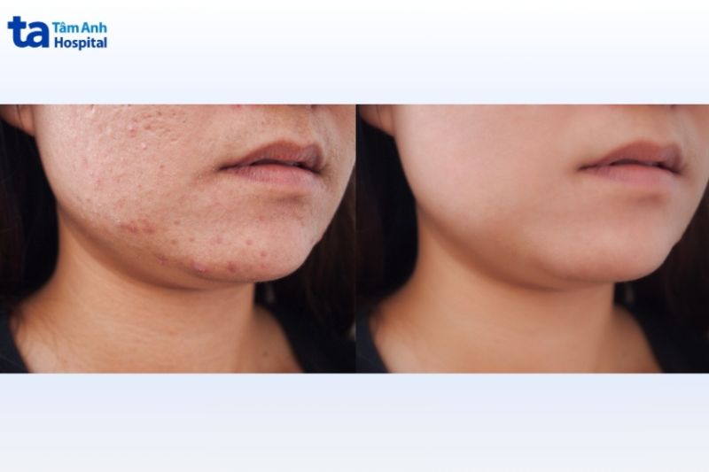 ảnh trước và sau khi dùng công nghệ rf xâm lân vi điểm điều trị mụn và chân lông to