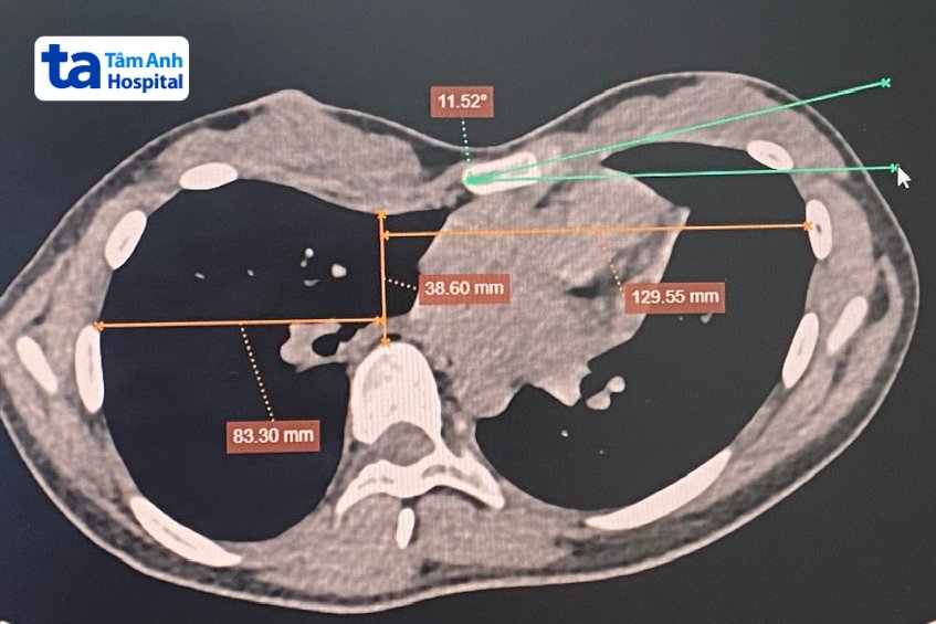 CT ngực trước mổ cho thấy lõm ngực nặng, chỉ số Haller là 6, xương ức xoắn 11,5 độ