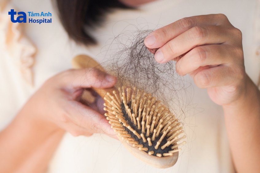 Cường giáp thường bị rụng tóc nhiều