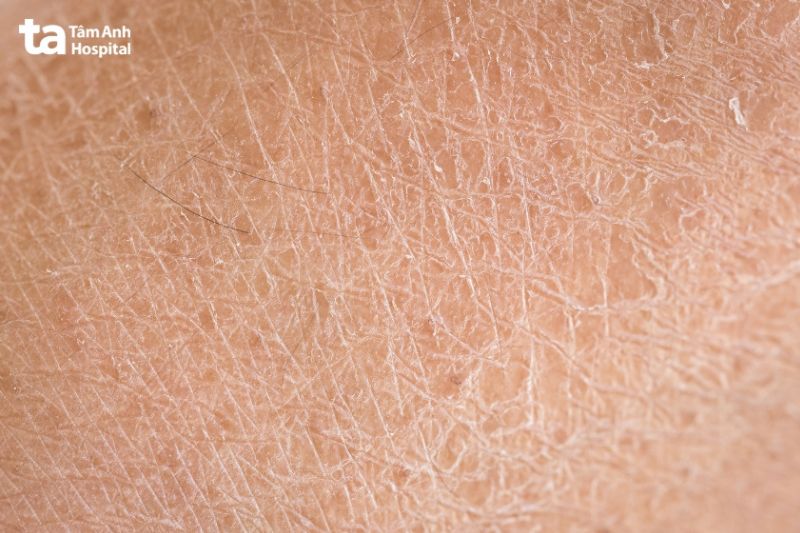 bề mặt da sần sùi bong tróc là dấu hiệu nhân biết da bạn đang bị khô