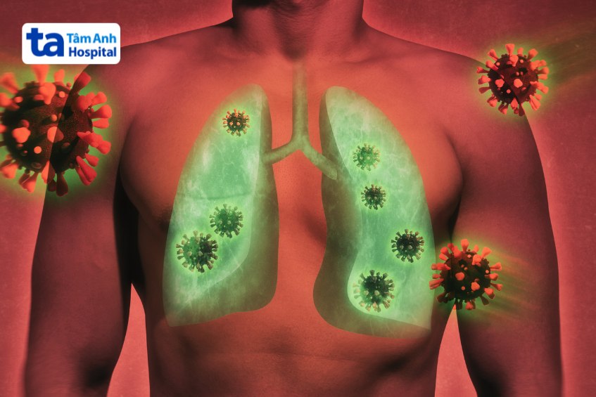 Đây là tình trạng nhiễm trùng lan rộng ở nhu mô phổi