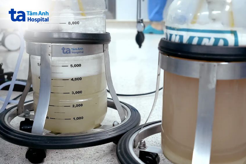 Dung dịch rửa phổi lắng các cặn lipoprotein