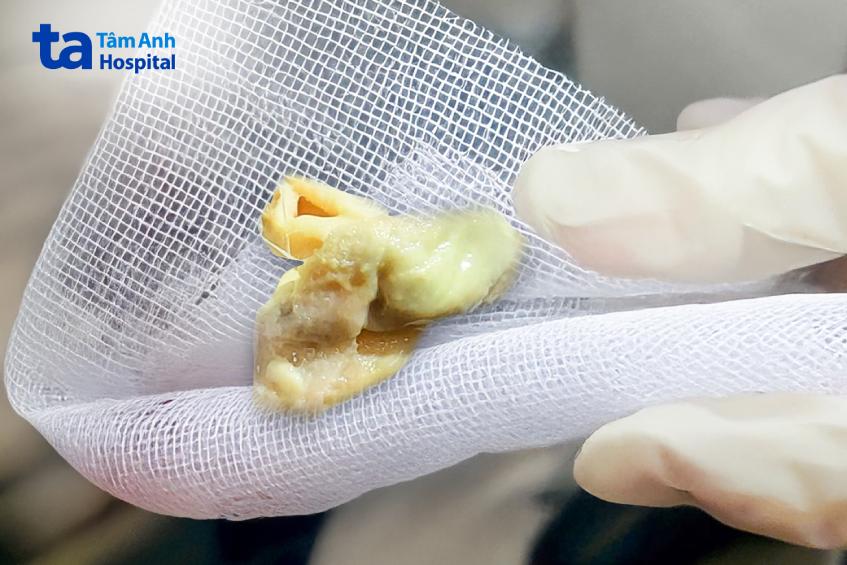 gạc meche bị bỏ quên