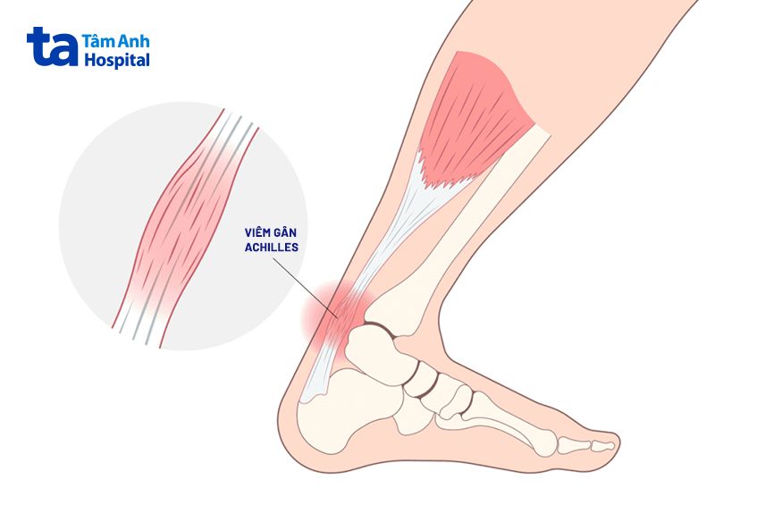 Gân Achilles bị rách gây đau