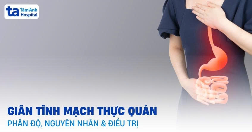 Giãn tĩnh mạch thực quản: Phân độ, nguyên nhân và điều trị