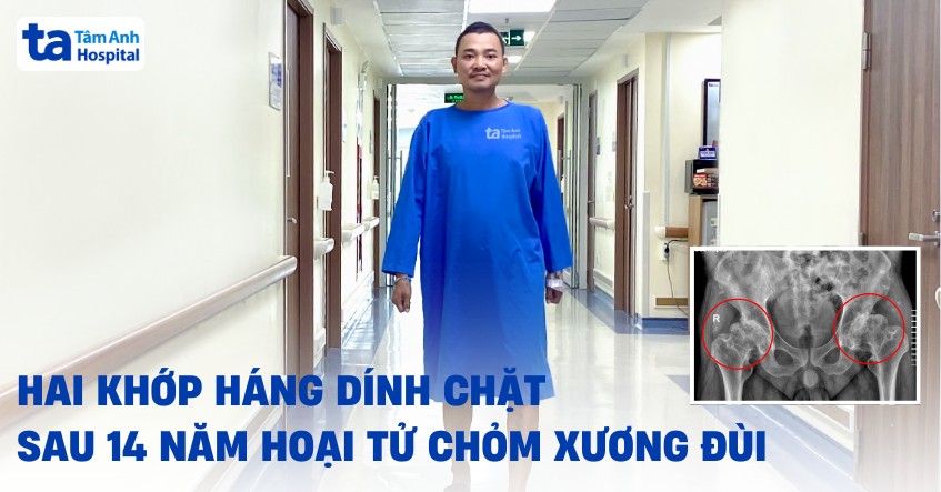 hai khớp háng dính chặt sau hoại tử chỏm xương đùi