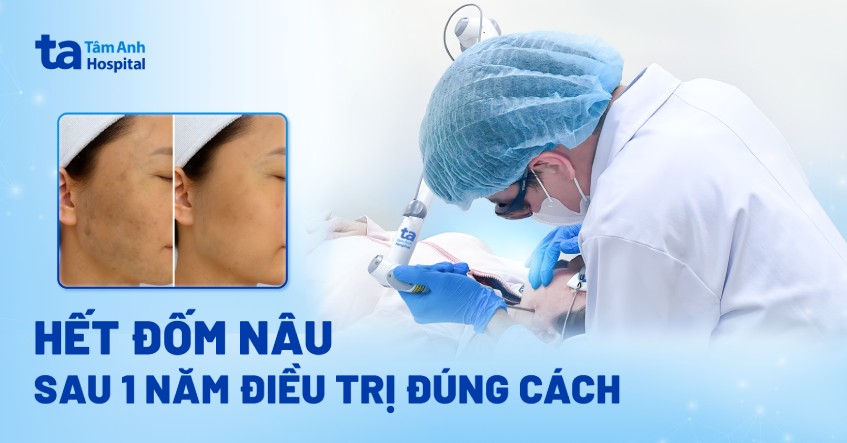hết đốm nâu sau 1 năm điều trị đúng cách