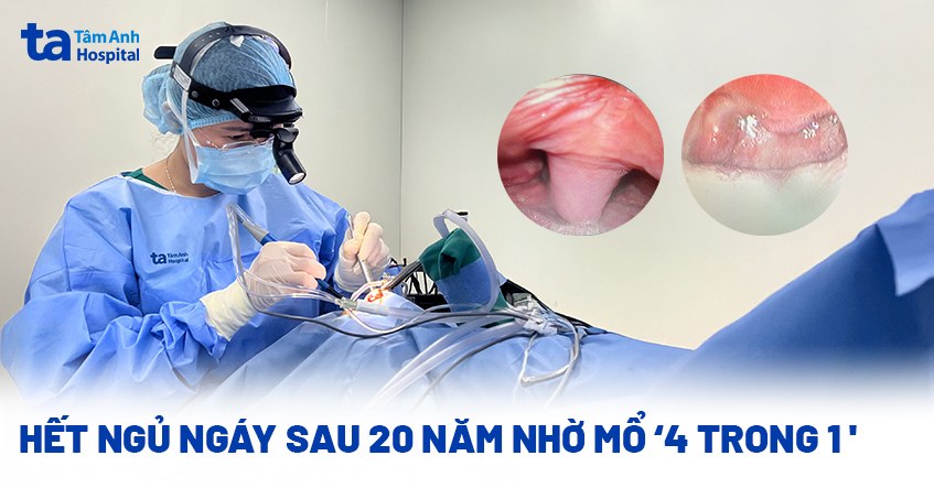 Hết ngủ ngáy sau 20 năm nhờ mổ ‘4 trong 1’