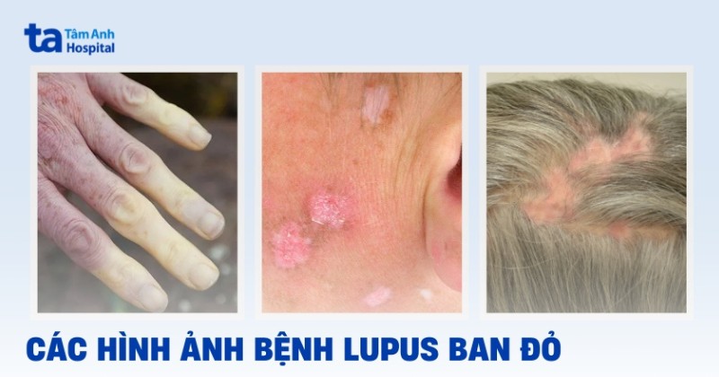 Hình ảnh bệnh lupus ban đỏ chi tiết qua từng giai đoạn