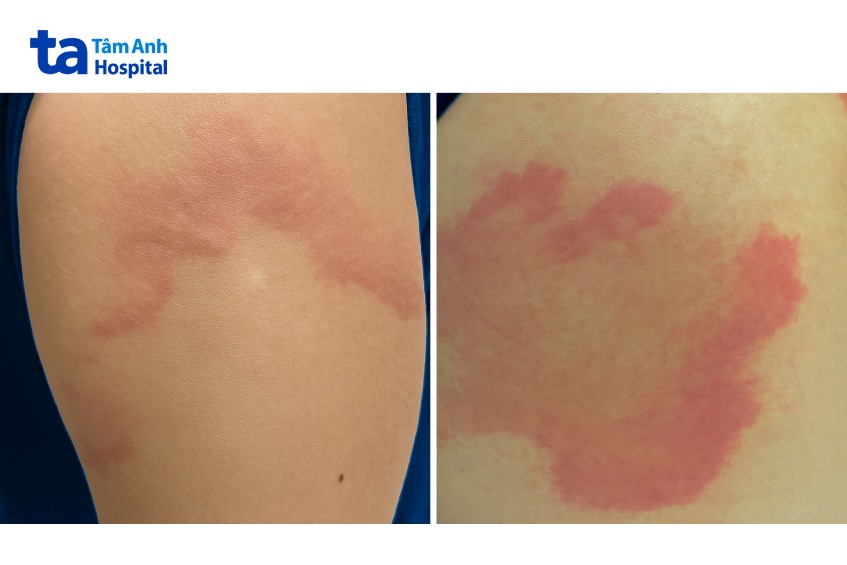 hình ảnh bệnh mề đay ở bệnh nhân