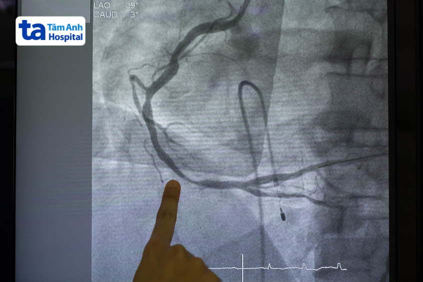 Hình ảnh chụp một trường hợp mạch vành có mức độ hẹp 70%