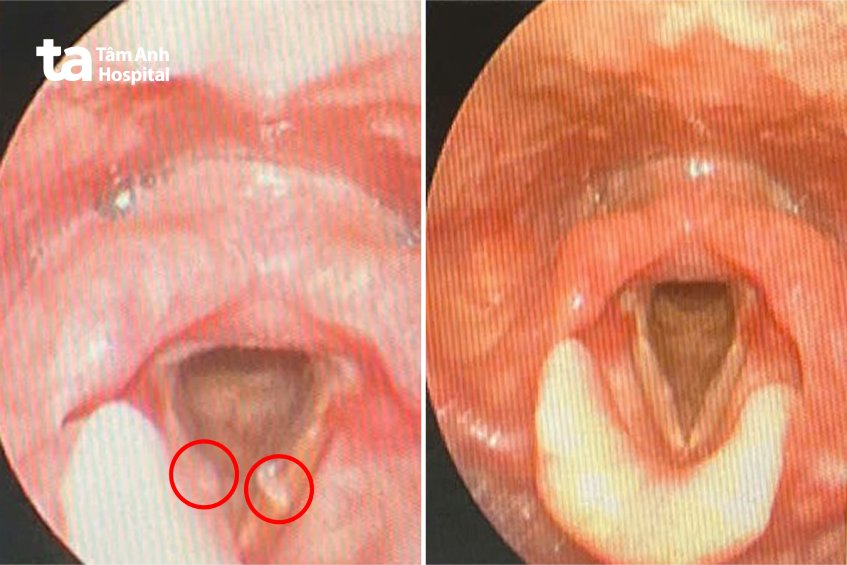 hình ảnh hạt xơ dây thanh của bệnh nhân