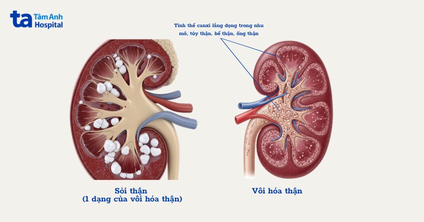 hình ảnh minh họa thận bị vôi hóa