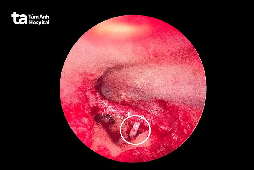 hình ảnh nội soi xương bàn đạp