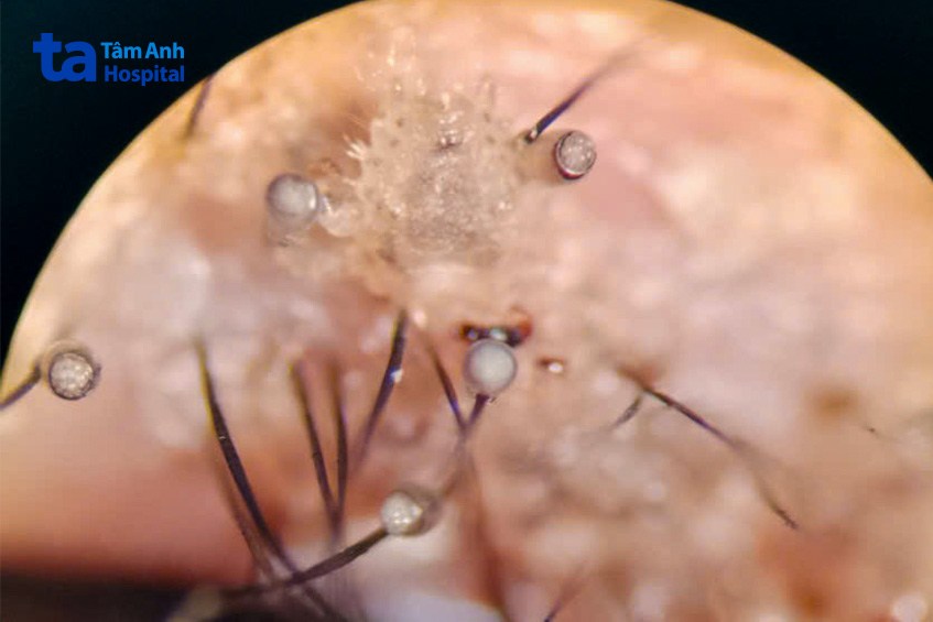 hình ảnh soi mắt dưới kính hiển vi