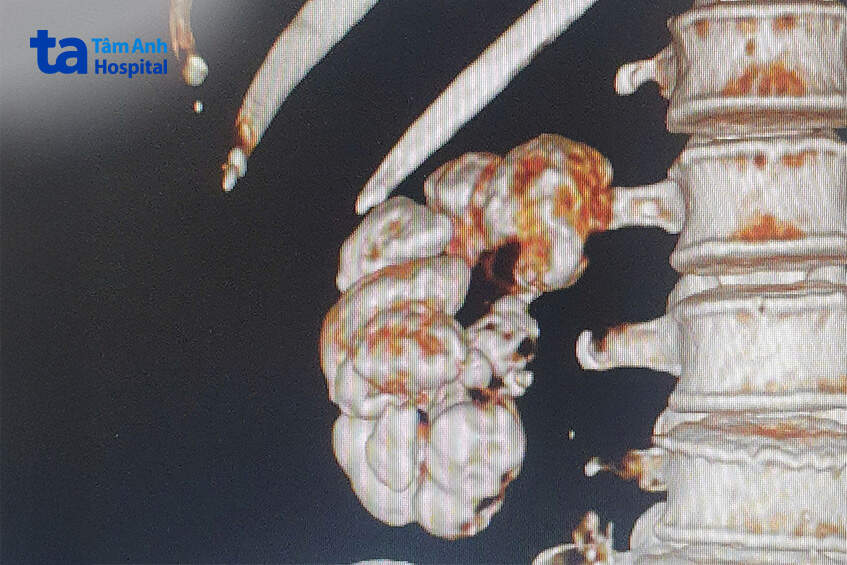 hình ảnh thận hóa đá trên ct