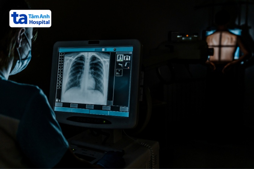 hình ảnh viêm phổi trên x quang