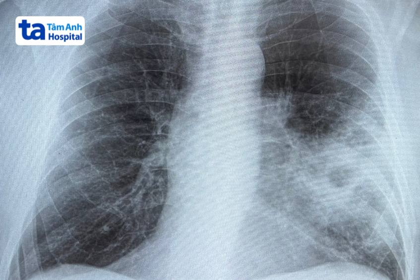 Hình ảnh X quang viêm phổi nặng bên trái ở người bệnh
