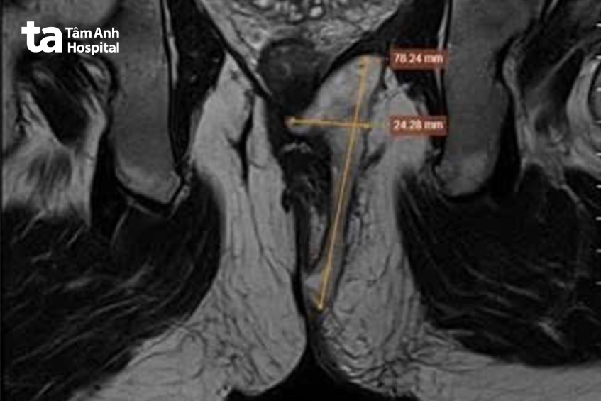 hình mri thấy đường rò