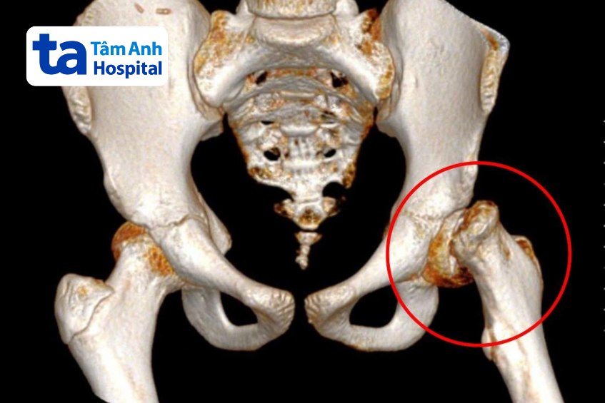 kết quả chụp ct 3d chỏm xương đùi trượt ra ngoài