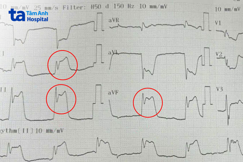 kết quả đo có đoạn st chênh lên