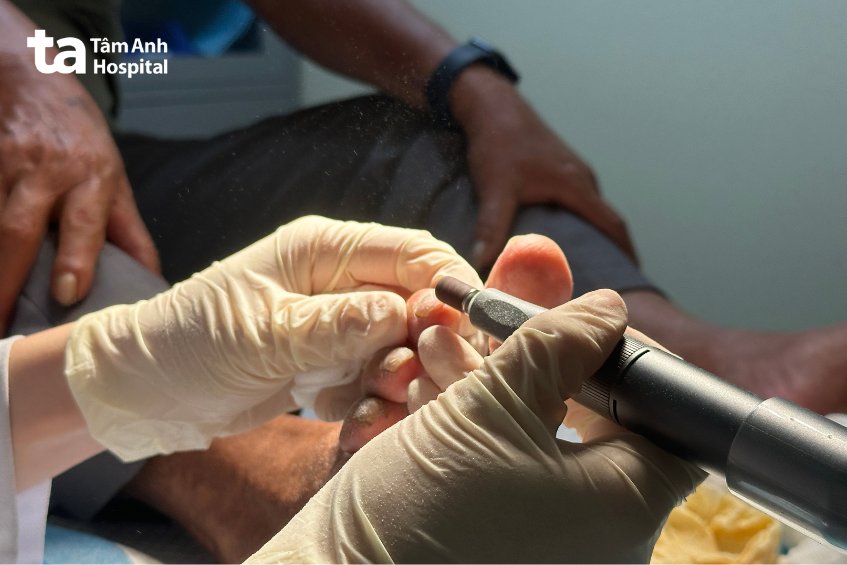 Khách hàng bị tiểu đường đang được chăm sóc bàn chân