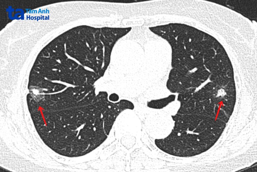 khối u phổi trên phim chụp cắt lớp vi tính