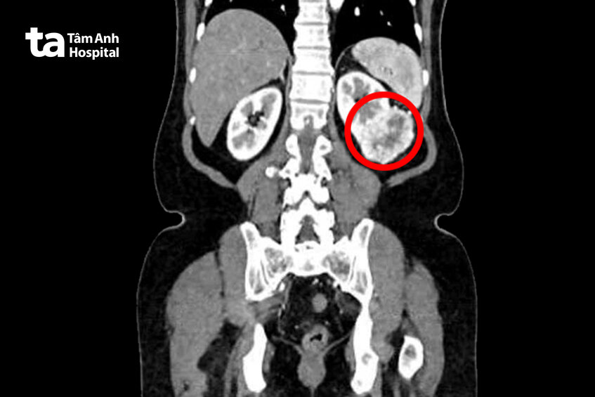 khối u thận trái nằm ở 1 3 giữa thận