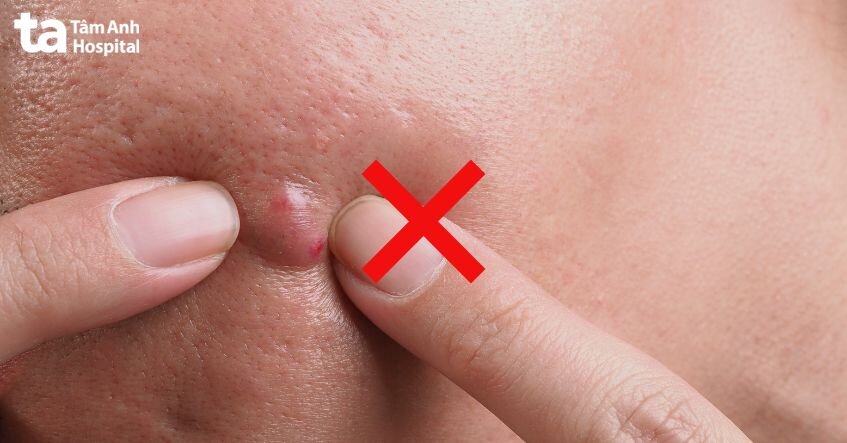 không được nặn mụn
