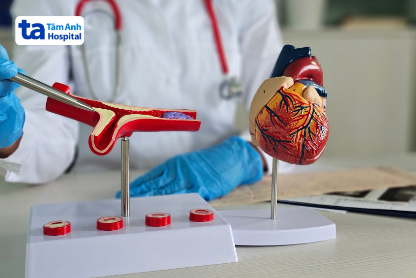 Mạch vành bị hẹp 70% là mức độ khá nặng, làm tăng biến chứng nguy hiểm