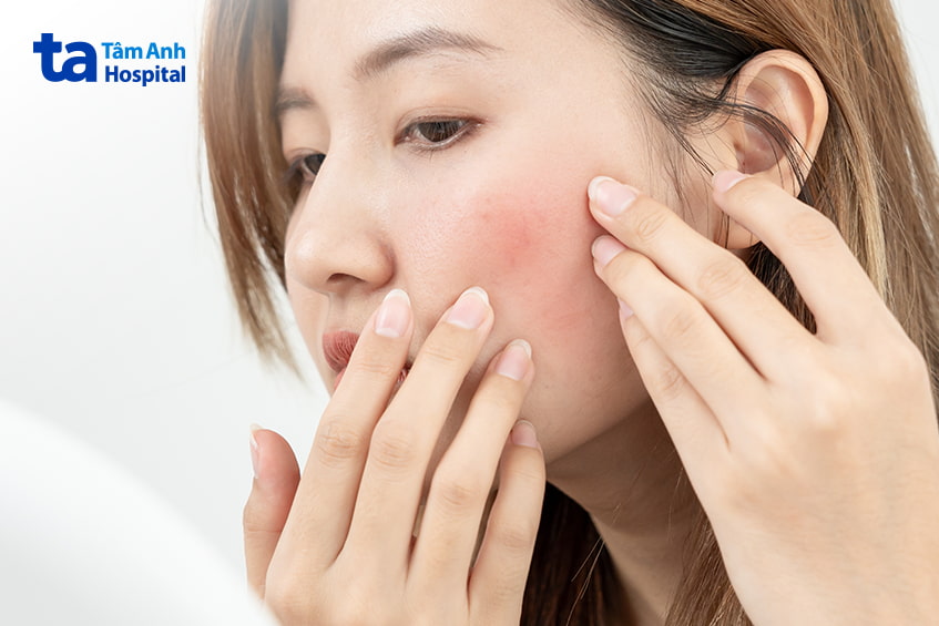 Người phụ nữ kiểm tra vùng da bị mẩn đỏ ngứa trên má trước khi điều trị bằng laser