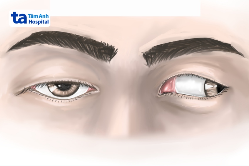 mắt lác sụp mí do liệt dây thần kinh sọ số 3