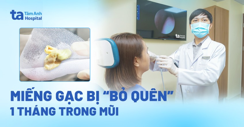 miếng gạc bị bỏ quên trong mũi