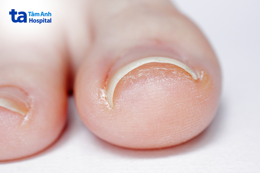Móng chân bị chọc thịt, phần mép móng cong đâm vào da gây tổn thương