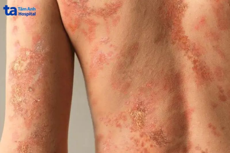 thể mủ toàn thân