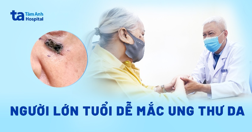 Người lớn tuổi dễ mắc ung thư da