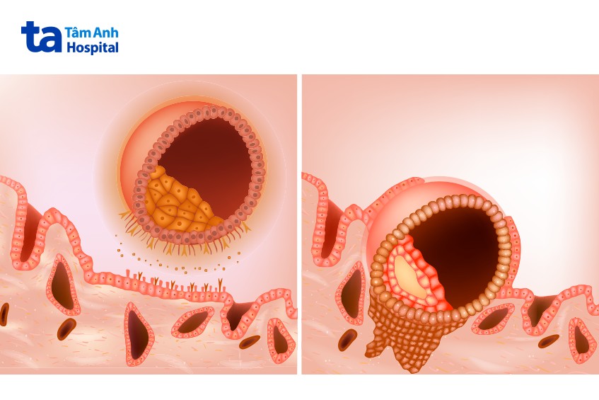Nguyên nhân chảy máu sau thủ thuật này có thể do phôi bám vào niêm mạc tử cung, làm vỡ các mao mạch nhỏ