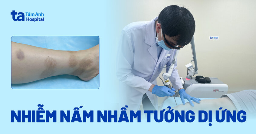 nhiễm nấm nhầm tưởng dị ứng