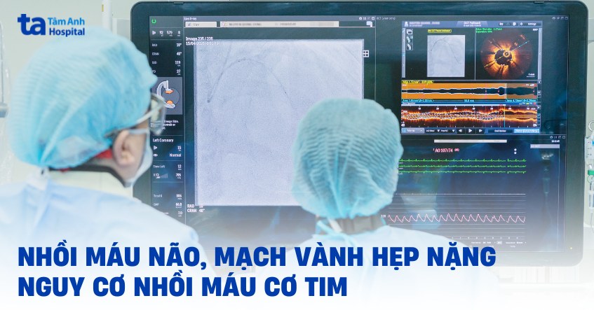 Nhồi máu não, mạch vành hẹp nặng nguy cơ nhồi máu cơ tim