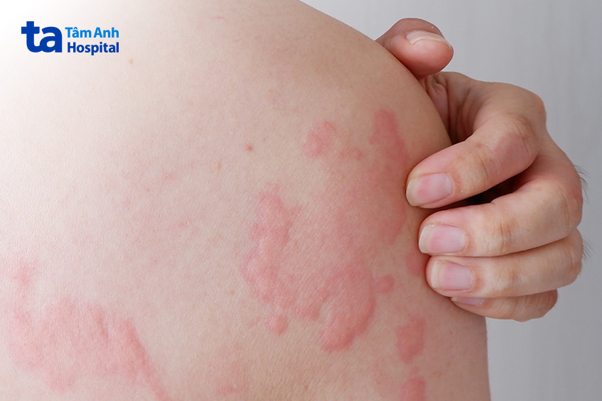 Bị nổi mẩn ngứa khắp người phải làm sao? Dấu hiệu và điều trị