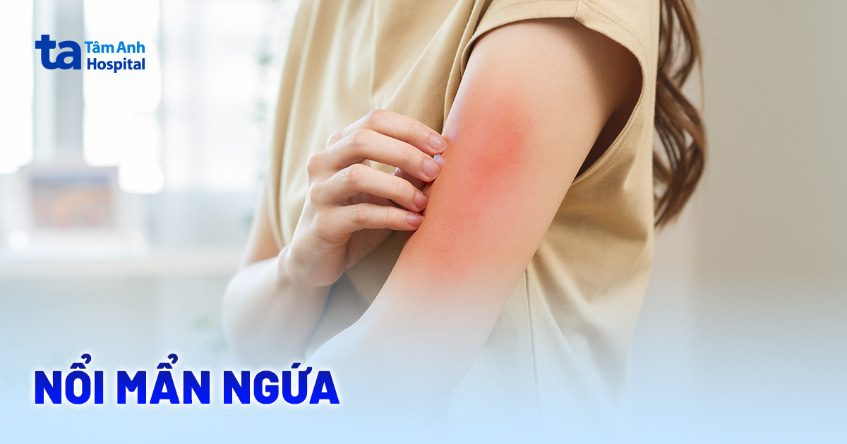 Bị nổi mẩn ngứa khắp người phải làm sao? Dấu hiệu và điều trị