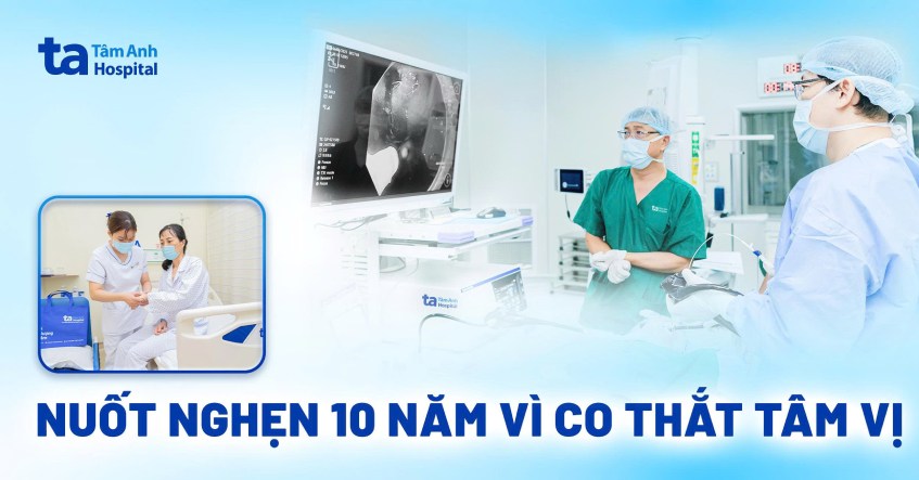 nuốt nghẹn 10 năm do co thắt tâm vị