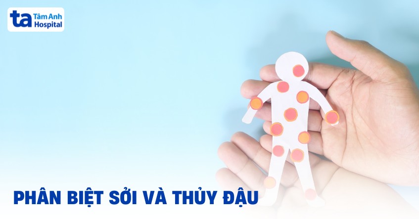 Phân biệt sởi và thủy đậu cụ thể và cách nhận biết từng loại