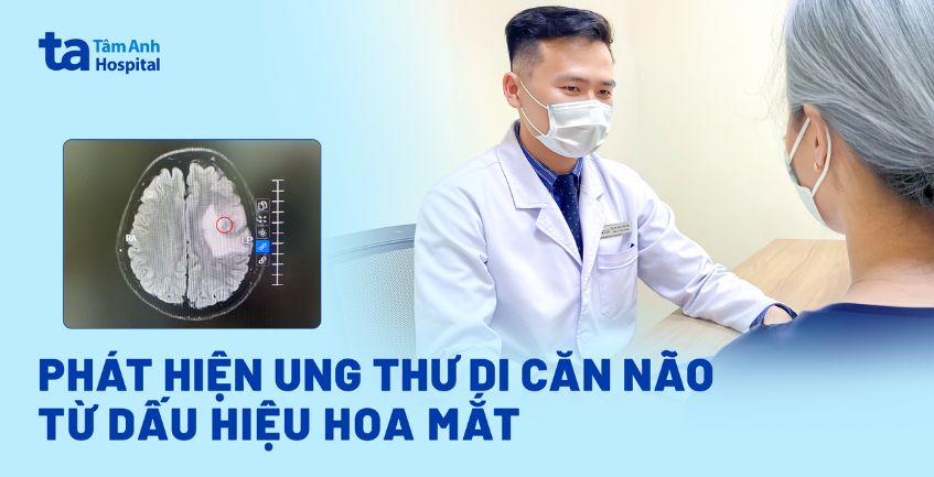 phát hiện ung thư di căn não do hoa mắt