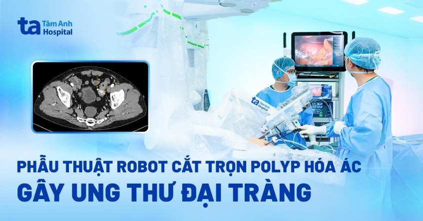 phẫu thuật robot cắt polyp hóa ác gây ung thư