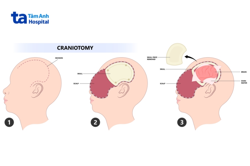 phẫu thuật thông qua tiếp cận xuyên sọ