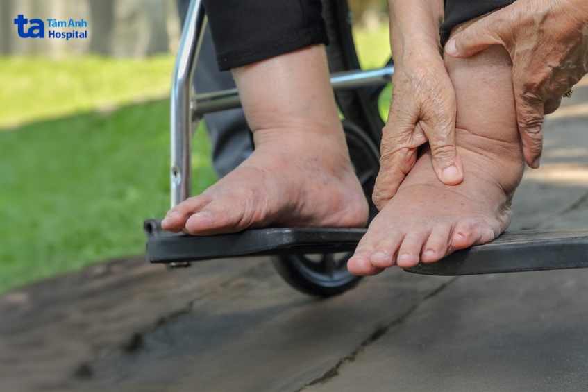 phù chân đi lại trở nên khó khăn hơn