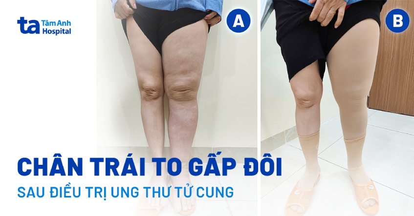 Phù chân voi sau điều trị ung thư tử cung