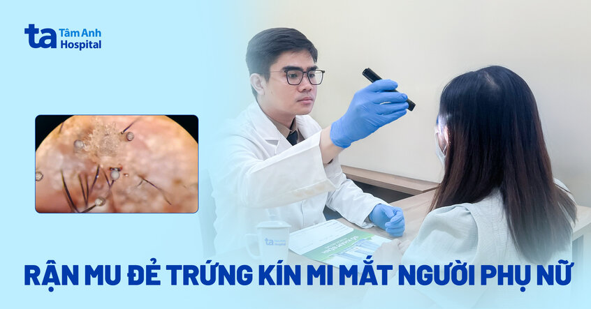 rận mu đẻ trứng trắng trên mi mắt người phụ nữ